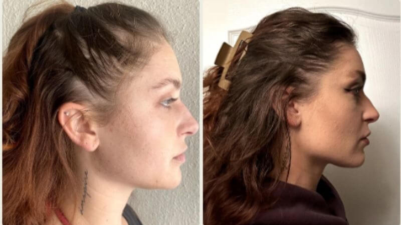 Jessica před zahájením a po 150 dnech používání vlasové rutiny Bio-Pilixin